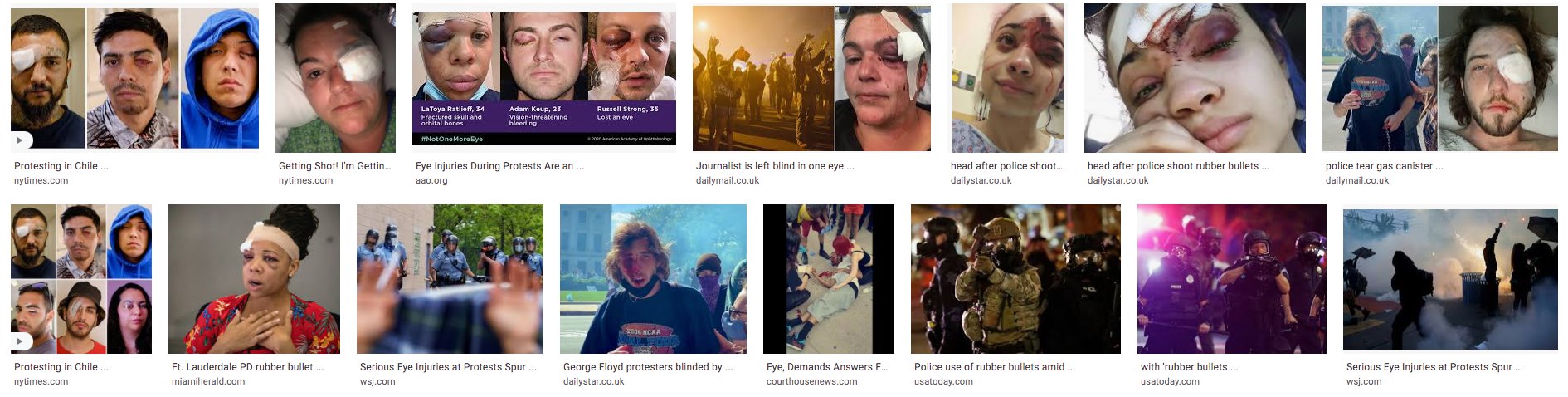 American protestors got eyes shot with rubber bullets for exercising their right to free speech